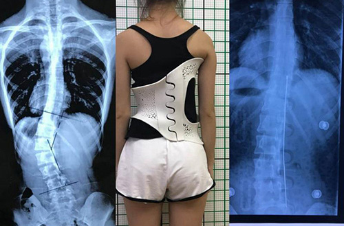 3D打印技術(shù)在骨科的實(shí)際應(yīng)用有哪些？(圖4)